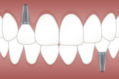 implant dentaire montreuil